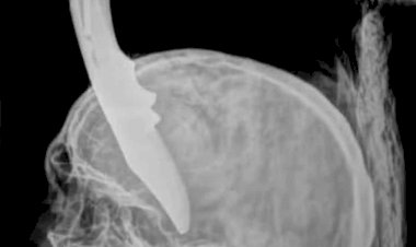 Homem de Alta Floresta passa por cirurgia após ser atacado com canivete