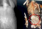 Idosa descobre que carregou “feto de pedra” por mais de 50 anos e morre após cirurgia de retirada