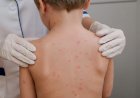 Casos de meningite acendem alerta para cuidados, mas Governo de MT descarta surto