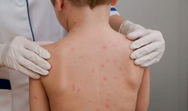 Casos de meningite acendem alerta para cuidados, mas Governo de MT descarta surto